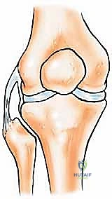 الاستئصال الجراحي