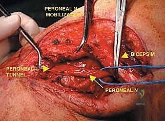 صورة توضيحية لـ استئصال الشظية: دليل شامل لمرضى أورام العظام وإنقاذ الأطراف مع الأستاذ الدكتور محمد هطيف في صنعاء