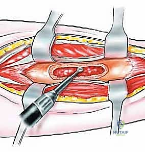 صورة توضيحية لـ استئصال الشظية
