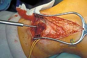 تخطيط جراحي