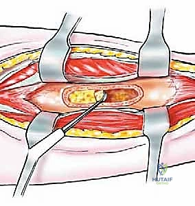 صورة توضيحية لـ استئصال الشظية: دليل شامل لمرضى أورام العظام وإنقاذ الأطراف مع الأستاذ الدكتور محمد هطيف في صنعاء
