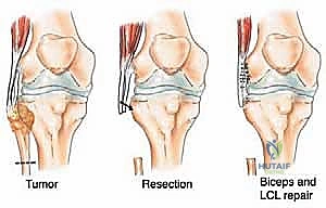 مرحلة التعافي