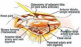 الاستئصال الجراحي
