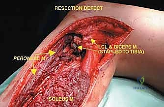 صورة توضيحية لـ استئصال الشظية: دليل شامل لمرضى أورام العظام وإنقاذ الأطراف مع الأستاذ الدكتور محمد هطيف في صنعاء