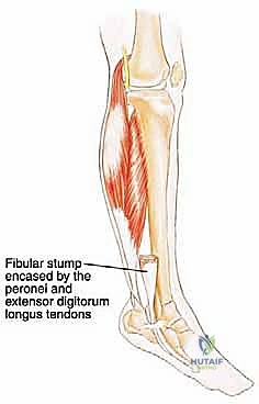 صورة طبية: استئصال الشظية: دليل شامل لمرضى أورام العظام وإنقاذ الأطراف مع الأستاذ الدكتور محمد هطيف في صنعاء