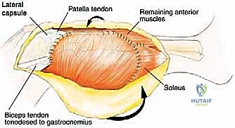 صورة توضيحية لـ استئصال الشظية: دليل شامل لمرضى أورام العظام وإنقاذ الأطراف مع الأستاذ الدكتور محمد هطيف في صنعاء