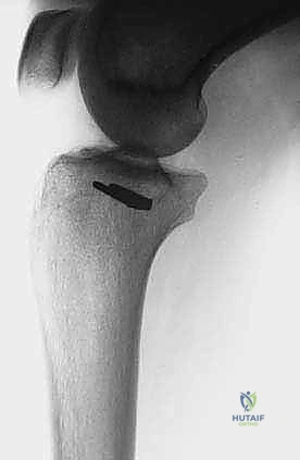 صورة توضيحية لـ استئصال الشظية: دليل شامل لمرضى أورام العظام وإنقاذ الأطراف مع الأستاذ الدكتور محمد هطيف في صنعاء