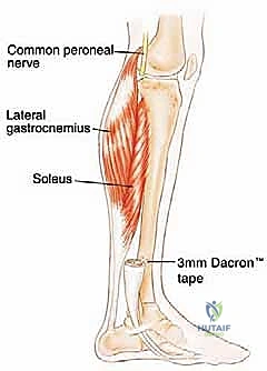 صورة توضيحية لـ استئصال الشظية: دليل شامل لمرضى أورام العظام وإنقاذ الأطراف مع الأستاذ الدكتور محمد هطيف في صنعاء