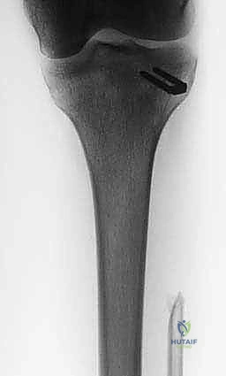 استئصال الشظية: دليل شامل لمرضى أورام العظام وإنقاذ الأطراف مع الأستاذ الدكتور محمد هطيف في صنعاء