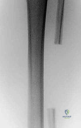 صورة توضيحية لـ استئصال الشظية: دليل شامل لمرضى أورام العظام وإنقاذ الأطراف مع الأستاذ الدكتور محمد هطيف في صنعاء