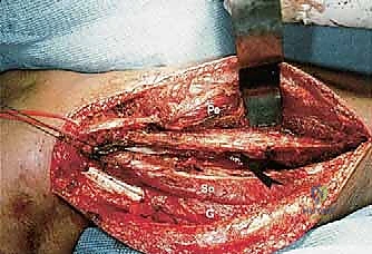 صورة طبية: استئصال الشظية: دليل شامل لمرضى أورام العظام وإنقاذ الأطراف مع الأستاذ الدكتور محمد هطيف في صنعاء