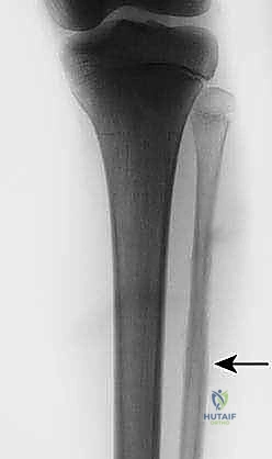 صورة توضيحية لـ استئصال الشظية: دليل شامل لمرضى أورام العظام وإنقاذ الأطراف مع الأستاذ الدكتور محمد هطيف في صنعاء