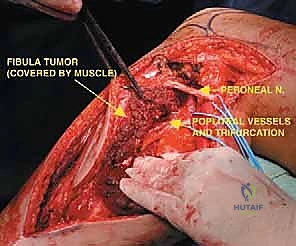 صورة توضيحية لـ استئصال الشظية: دليل شامل لمرضى أورام العظام وإنقاذ الأطراف مع الأستاذ الدكتور محمد هطيف في صنعاء