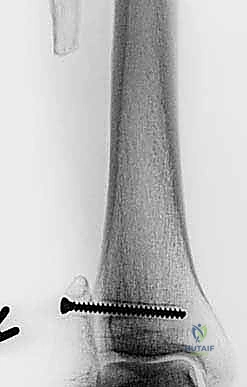 صورة توضيحية لـ استئصال الشظية: دليل شامل لمرضى أورام العظام وإنقاذ الأطراف مع الأستاذ الدكتور محمد هطيف في صنعاء