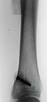 صورة توضيحية لـ استئصال الشظية: دليل شامل لمرضى أورام العظام وإنقاذ الأطراف مع الأستاذ الدكتور محمد هطيف في صنعاء