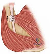 Illustration of pectoralis major repair - Dr. Mohammed Hutaif