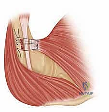 تثبيت الوتر في العظم باستخدام الأزرار أو المثبتات