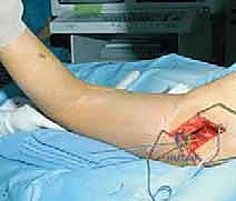 التهاب المفاصل التنكسي المبكر كأحد دواعي الجراحة