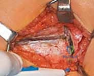 التخطيط الجراحي باستخدام الأشعة المقطعية ثلاثية الأبعاد