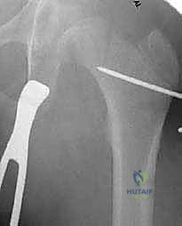 الشق الجراحي الدقيق والوصول إلى عظم الفخذ