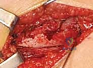 تحضير مسار الشريحة داخل عظم الفخذ