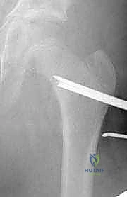 صورة شعاعية نهائية توضح نجاح التثبيت بالشريحة