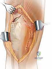 Revision Total Knee Arthroplasty with Extensile Exposure: V-Y Quadricepsplasty Masterclass