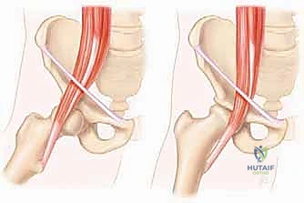 النوع الخارجي لمتلازمة الورك