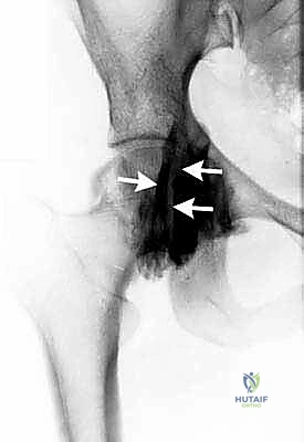 الفحص السريري للورك الطاطئ