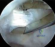 إدارة متلازمة الورك الطاطئ بالمنظار دليل شامل للمرضى مع الأستاذ الدكتور محمد هطيف