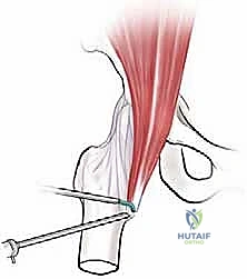 تأثير الرياضة على مفصل الورك