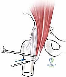 النوع الداخلي لمتلازمة الورك