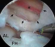 صورة توضيحية لـ إدارة متلازمة الورك الطاطئ بالمنظار دليل شامل للمرضى مع الأستاذ الدكتور محمد هطيف