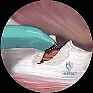 دور الرنين المغناطيسي في التشخيص