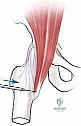 صورة توضيحية لـ إدارة متلازمة الورك الطاطئ بالمنظار دليل شامل للمرضى مع الأستاذ الدكتور محمد هطيف