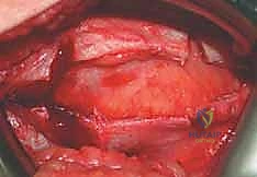 صورة توضيحية لـ إدارة متلازمة الورك الطاطئ بالمنظار دليل شامل للمرضى مع الأستاذ الدكتور محمد هطيف