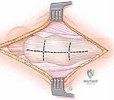 صورة طبية: إدارة متلازمة الورك الطاطئ بالمنظار دليل شامل للمرضى مع الأستاذ الدكتور محمد هطيف