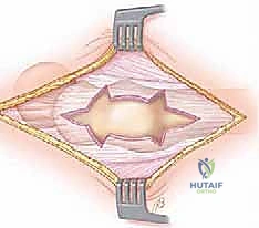 صورة طبية: إدارة متلازمة الورك الطاطئ بالمنظار دليل شامل للمرضى مع الأستاذ الدكتور محمد هطيف