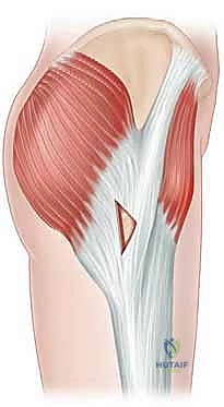 صورة طبية: إدارة متلازمة الورك الطاطئ بالمنظار دليل شامل للمرضى مع الأستاذ الدكتور محمد هطيف