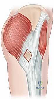 صورة توضيحية لـ إدارة متلازمة الورك الطاطئ بالمنظار دليل شامل للمرضى مع الأستاذ الدكتور محمد هطيف