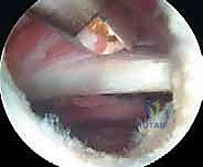 صورة توضيحية لـ إدارة متلازمة الورك الطاطئ بالمنظار دليل شامل للمرضى مع الأستاذ الدكتور محمد هطيف