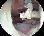 Endoscopic Management of Snapping Hip Syndrome: An Intraoperative Masterclass