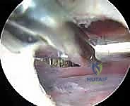 صورة توضيحية لـ إدارة متلازمة الورك الطاطئ بالمنظار دليل شامل للمرضى مع الأستاذ الدكتور محمد هطيف