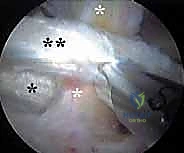 صورة طبية: إدارة متلازمة الورك الطاطئ بالمنظار دليل شامل للمرضى مع الأستاذ الدكتور محمد هطيف