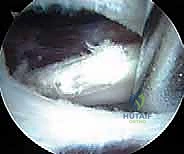 صورة طبية: إدارة متلازمة الورك الطاطئ بالمنظار دليل شامل للمرضى مع الأستاذ الدكتور محمد هطيف