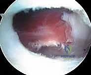 صورة طبية: إدارة متلازمة الورك الطاطئ بالمنظار دليل شامل للمرضى مع الأستاذ الدكتور محمد هطيف