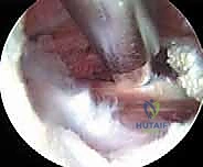 صورة طبية: إدارة متلازمة الورك الطاطئ بالمنظار دليل شامل للمرضى مع الأستاذ الدكتور محمد هطيف