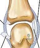 آفة ستينر في مفصل الإبهام