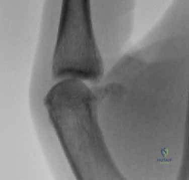 صورة توضيحية لـ إصلاح أربطة مفصل إبهام اليد (MCP): دليل شامل للمرضى مع الأستاذ الدكتور محمد هطيف