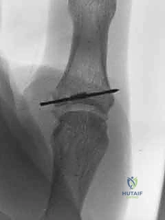 صورة توضيحية لـ إصلاح أربطة مفصل إبهام اليد (MCP): دليل شامل للمرضى مع الأستاذ الدكتور محمد هطيف